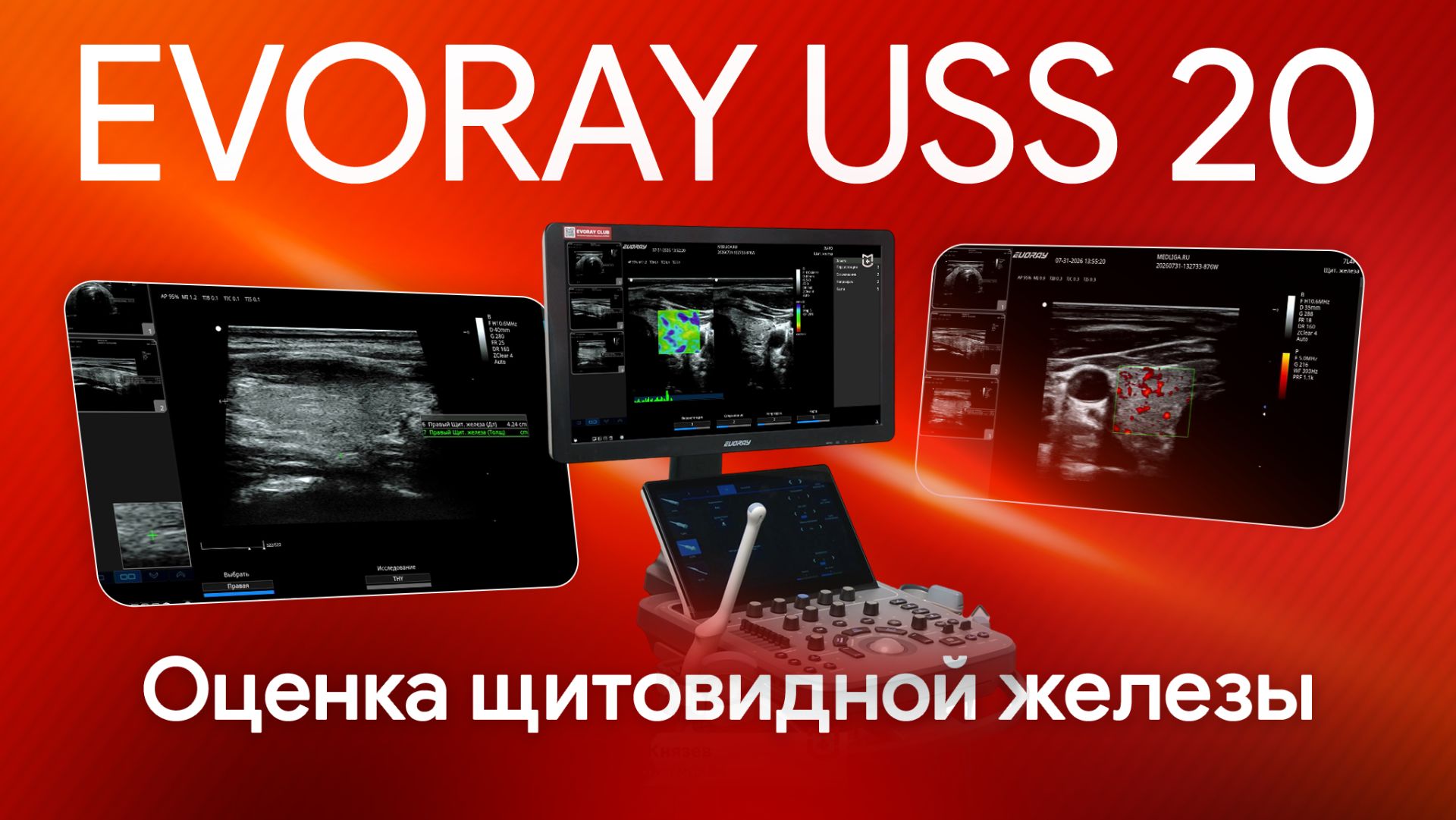 УЗИ щитовидной железы