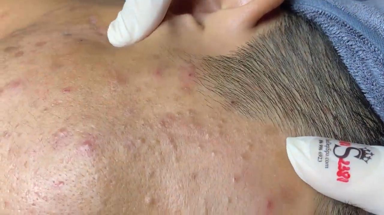 523 • Acne Collection • АСМР • Relax Spa