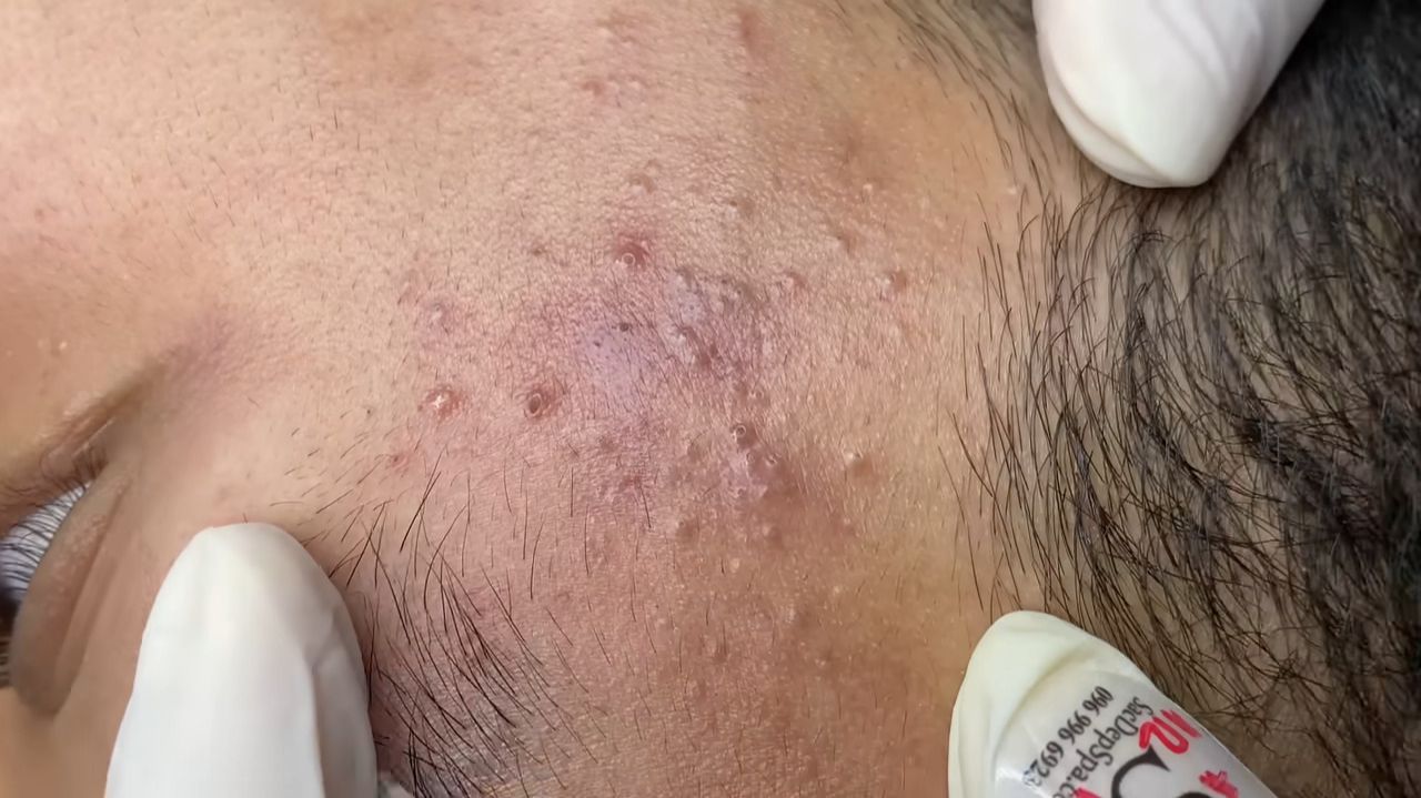 528 • Acne Collection • АСМР • Relax Spa