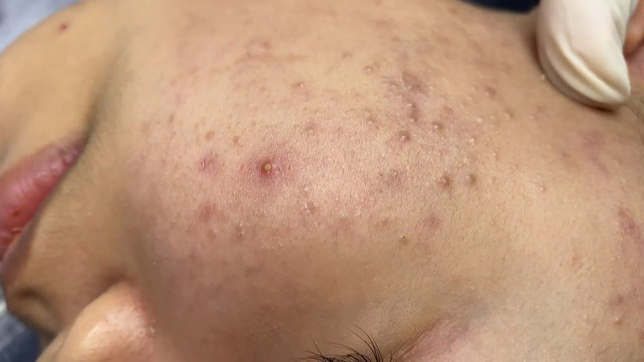 534 • Acne Collection • АСМР • Relax Spa