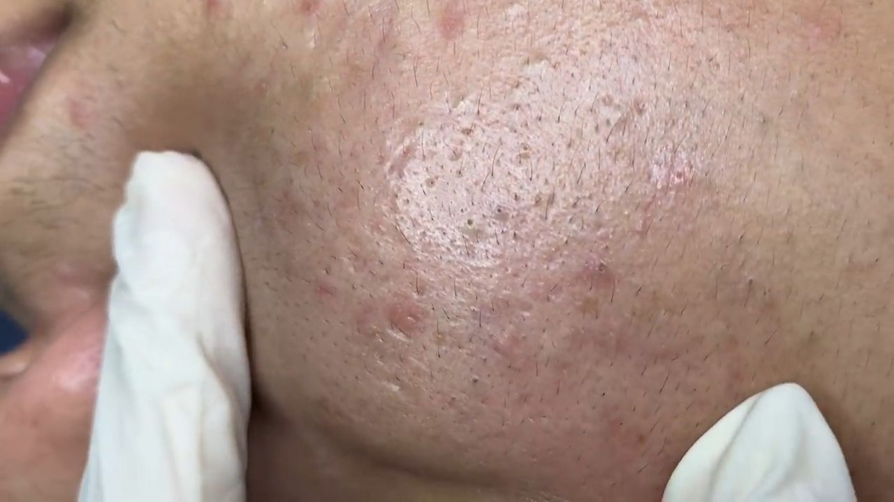 532 • Acne Collection • АСМР • Relax Spa