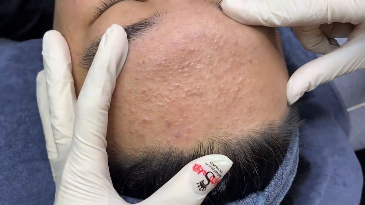 533 • Acne Collection • АСМР • Relax Spa