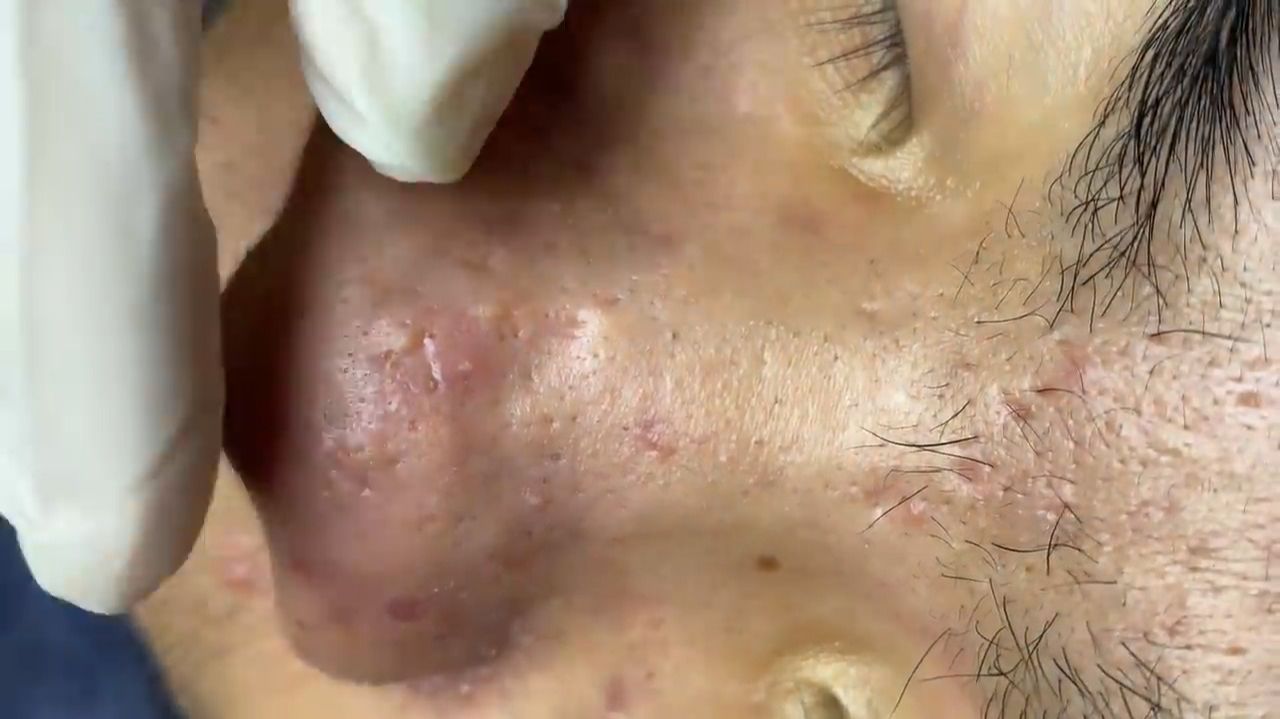 529 • Acne Collection • АСМР • Relax Spa