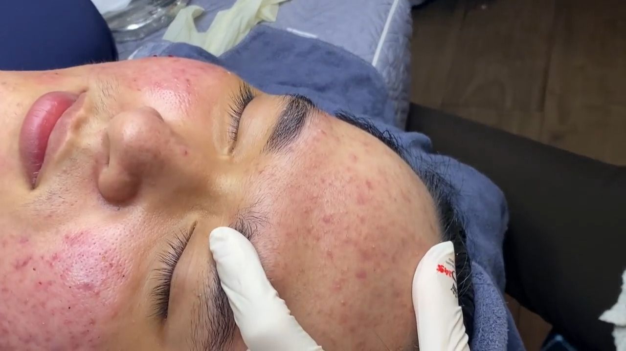 535 • Acne Collection • АСМР • Relax Spa