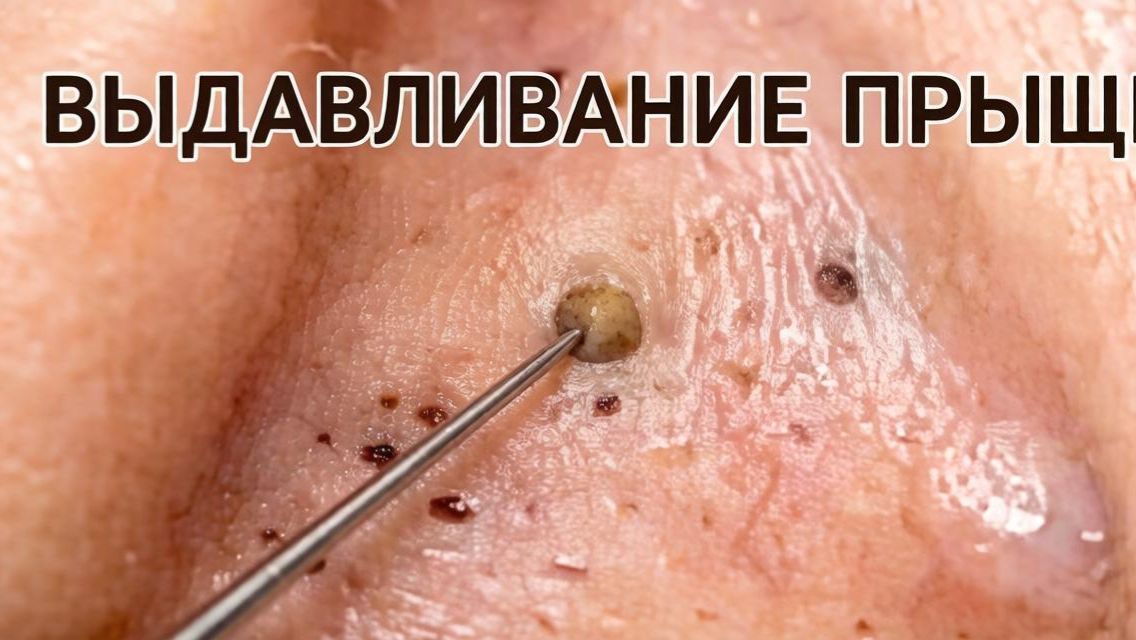 Выдавливание прыщей №5