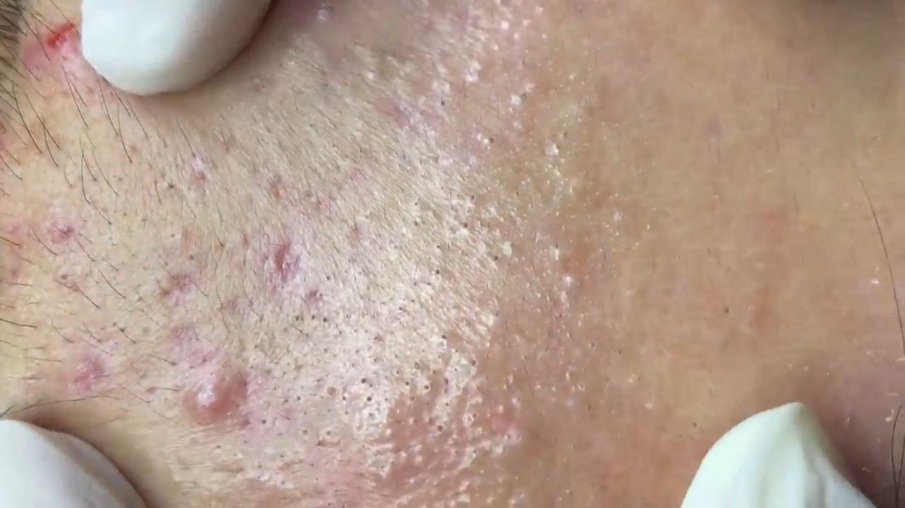 538 • Acne Collection • АСМР • Relax Spa