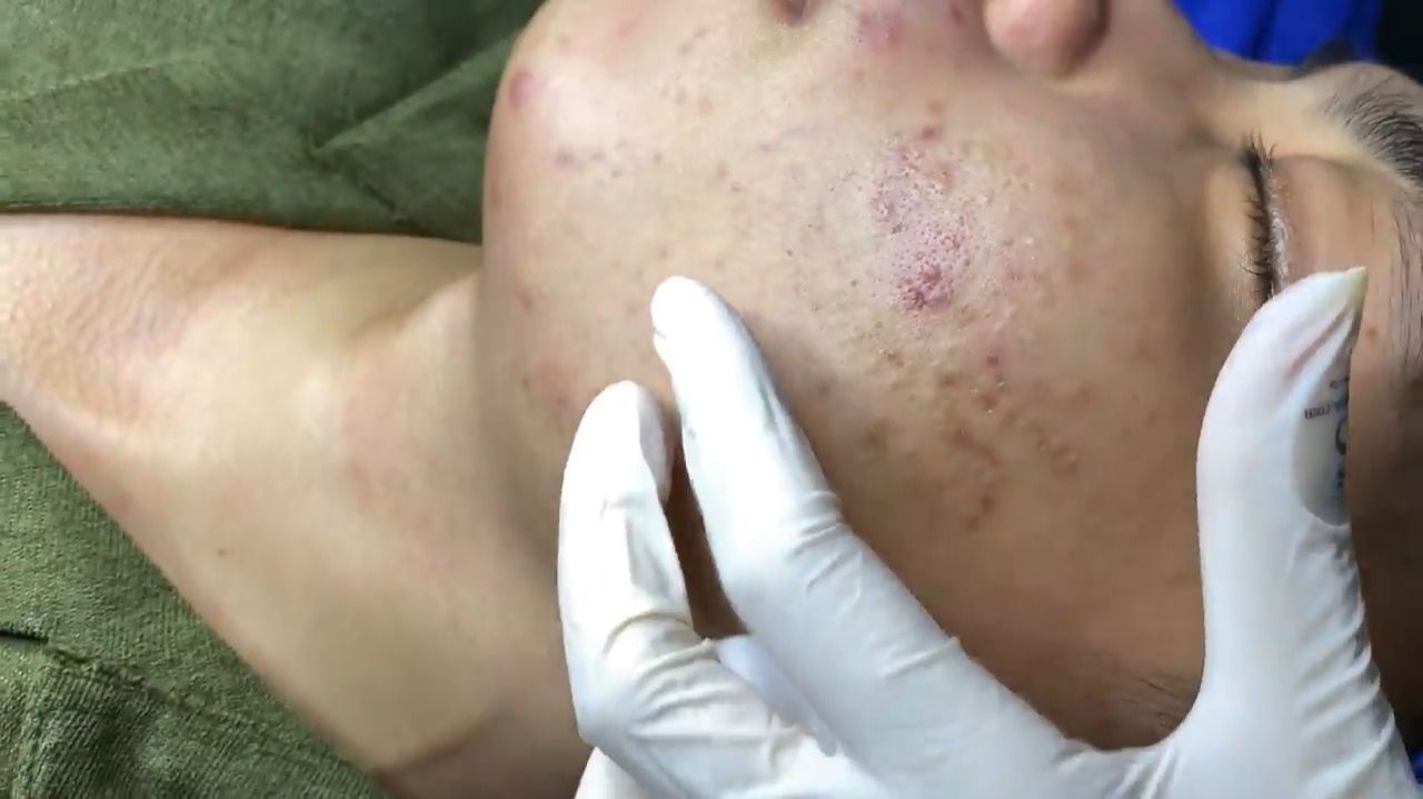 537 • Acne Collection • АСМР • Relax Spa