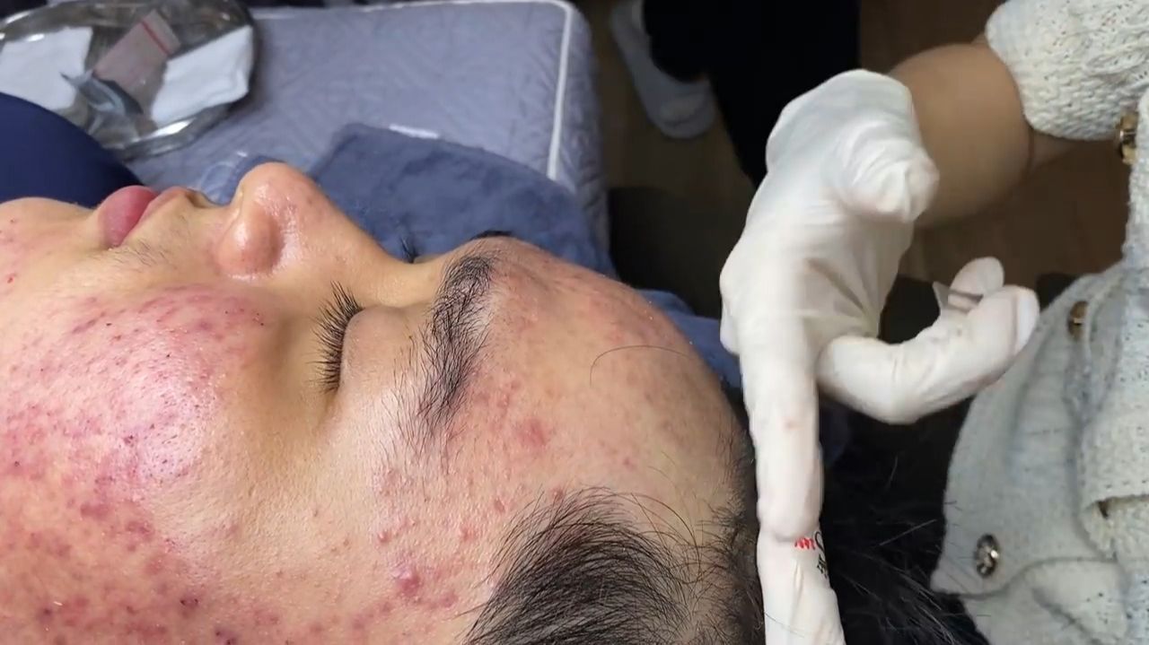 536 • Acne Collection • АСМР • Relax Spa