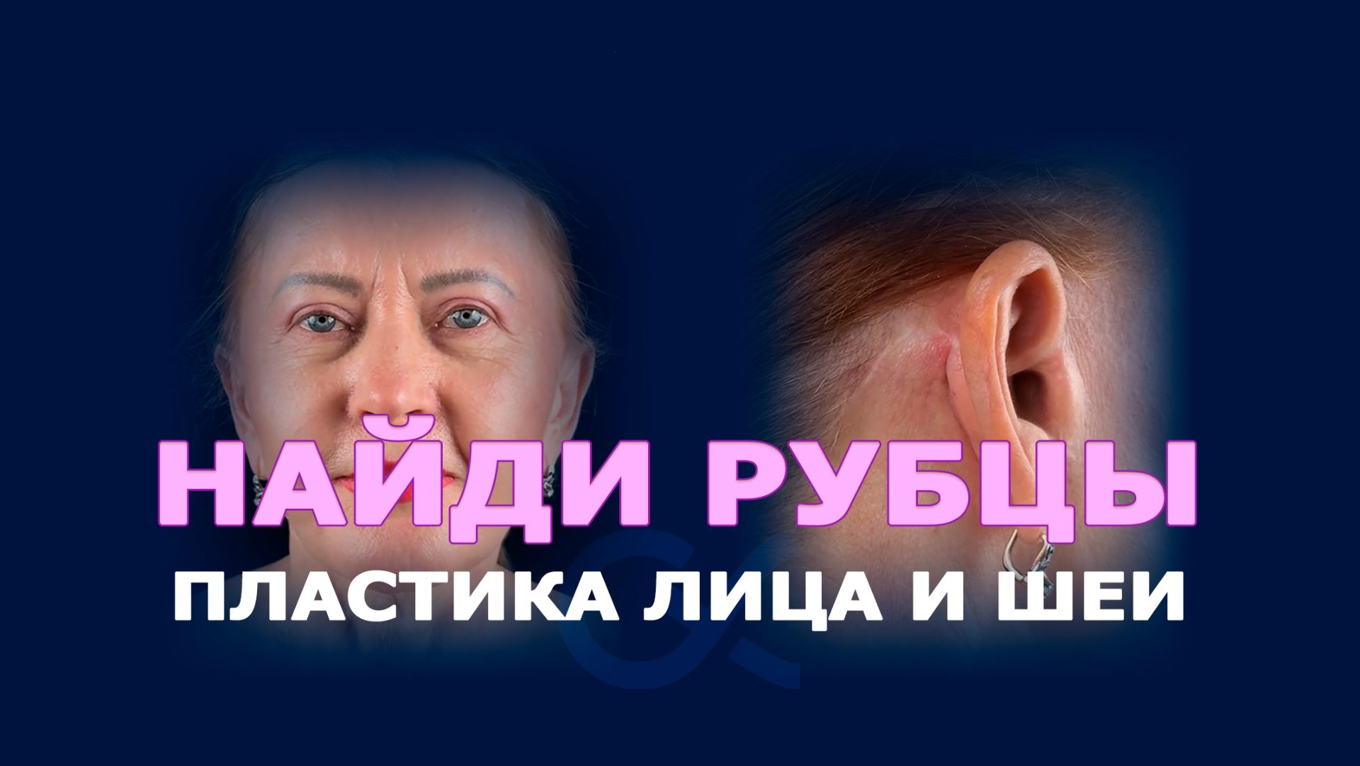 Пластика лица и шеи