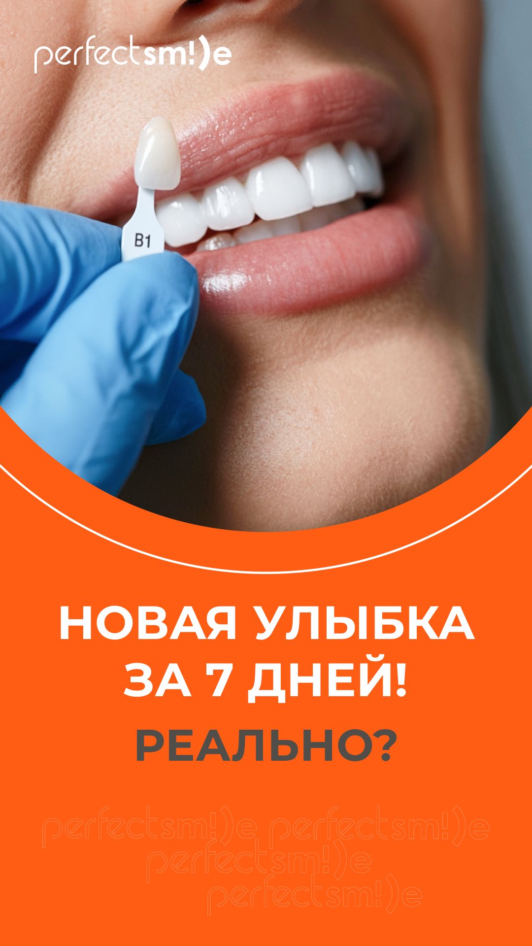 Виниры