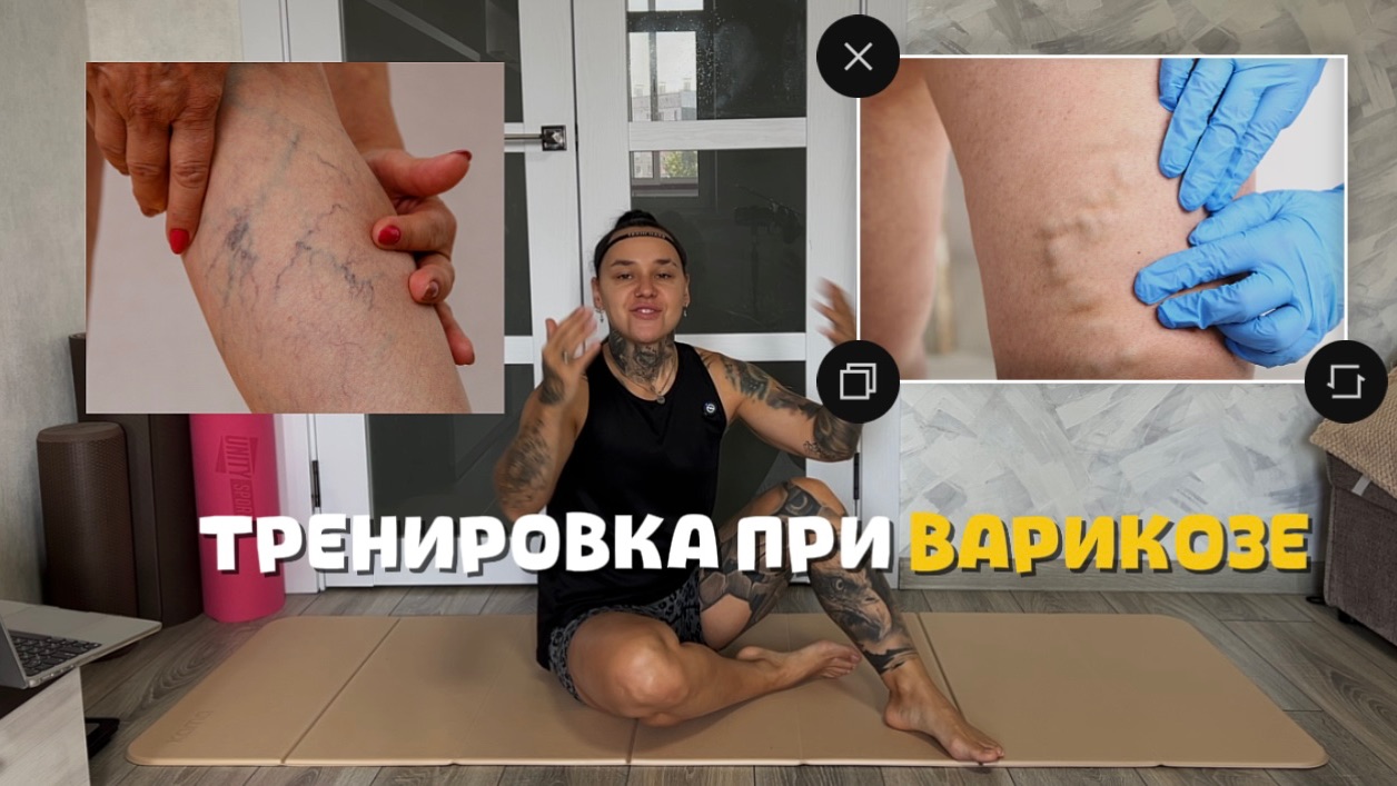 ТРЕНИРОВКА ПРИ ВАРИКОЗЕ ВЕН