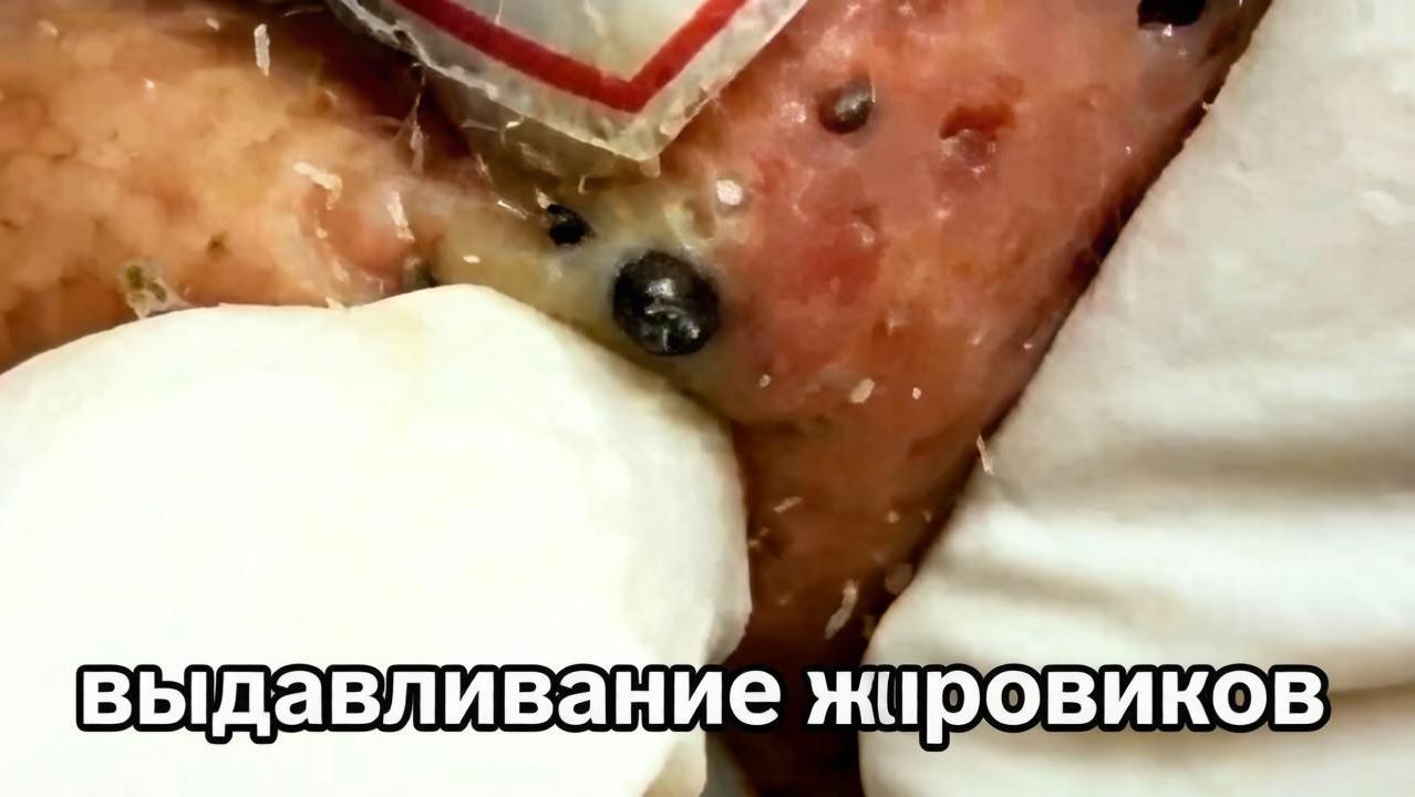 Выдавливание жировиков