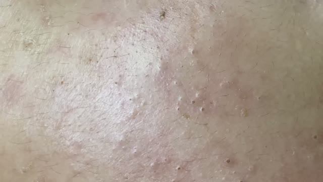 Механическая чистка от прыщей — чистая кожа без фильтров