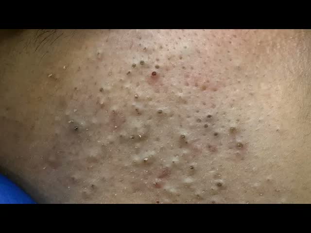 [ASMR] Удаление чёрных и белых точек, глубокая чистка лица и выдавливание прыщей