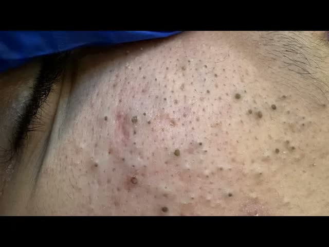 ASMR уход за кожей: мягкое глубокое очищение и выдавливание прыщей для чистой кожи!