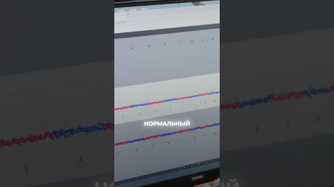 Как определить синдром дауна у эмбриона
