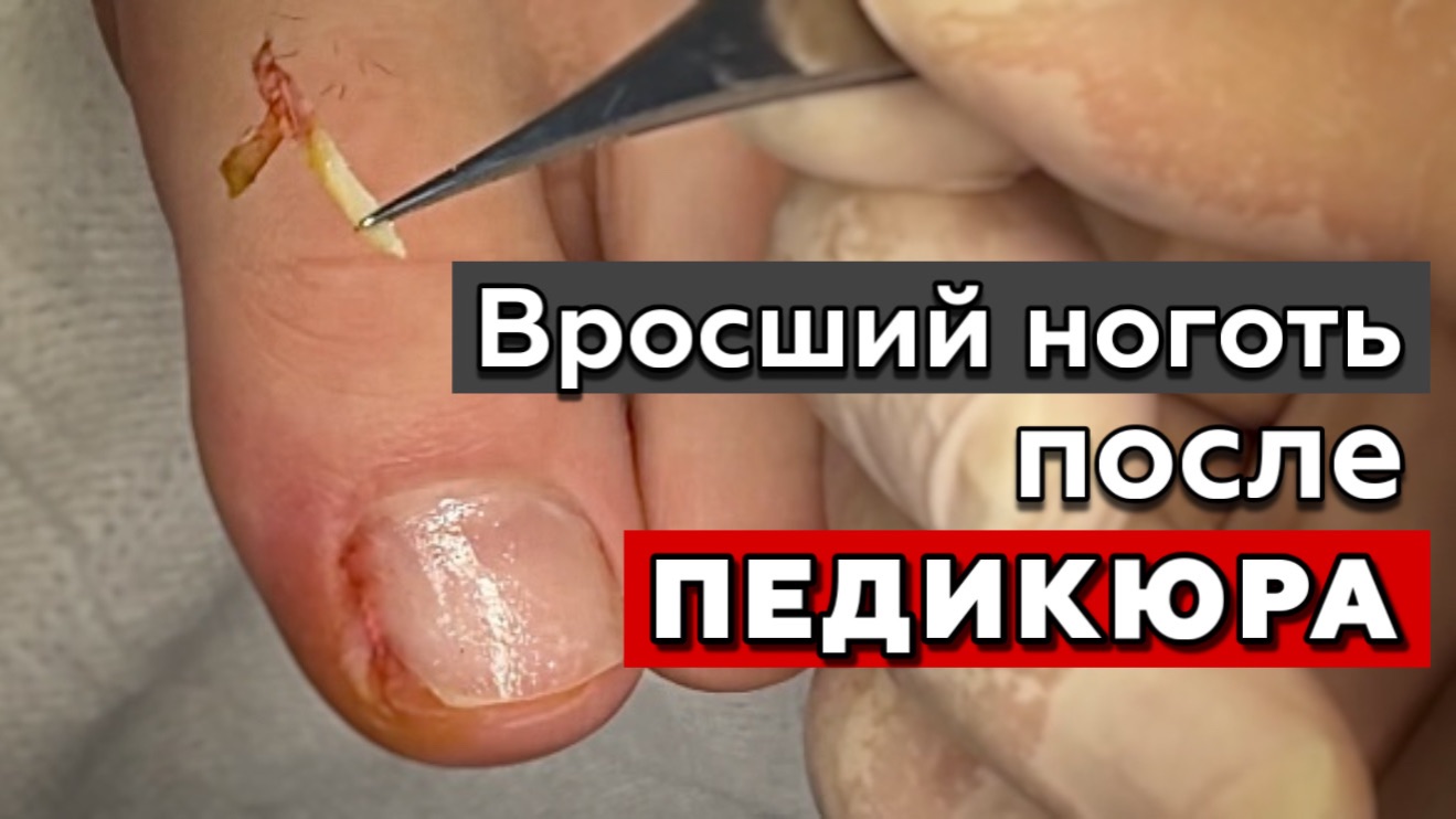 Ноготь врос после педикюра