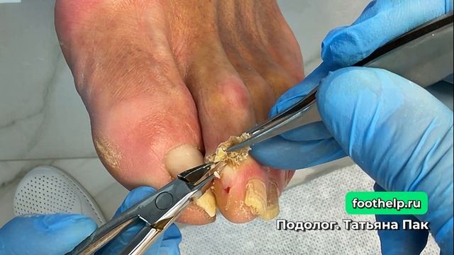 Межпальцевая мозоль
