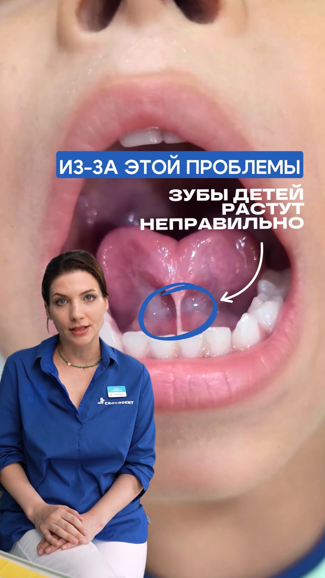 На что влияет короткая уздечка языка👉
