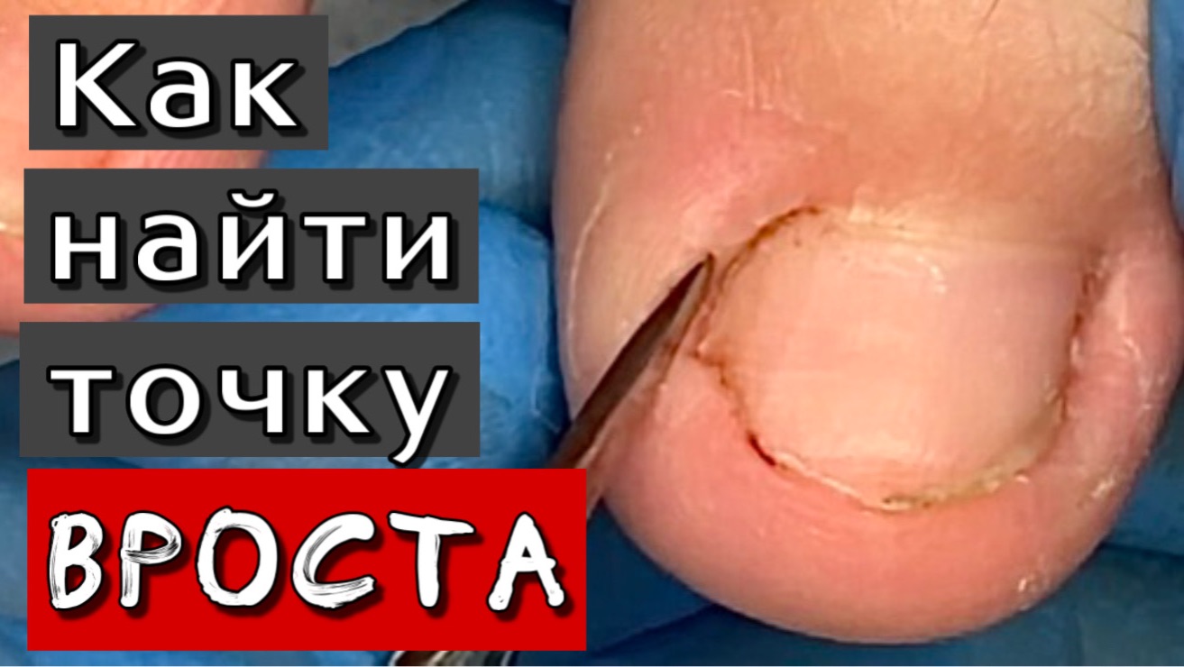 Вросший ноготь