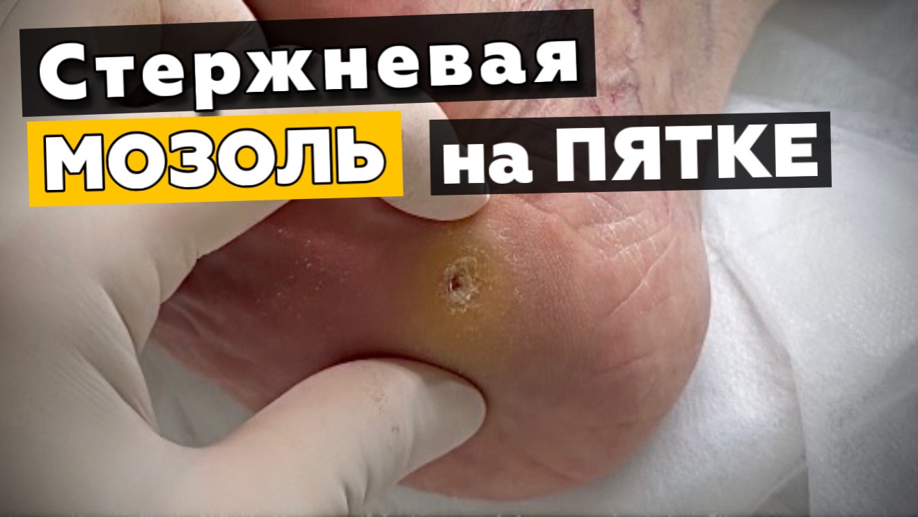 Пяточная мозоль