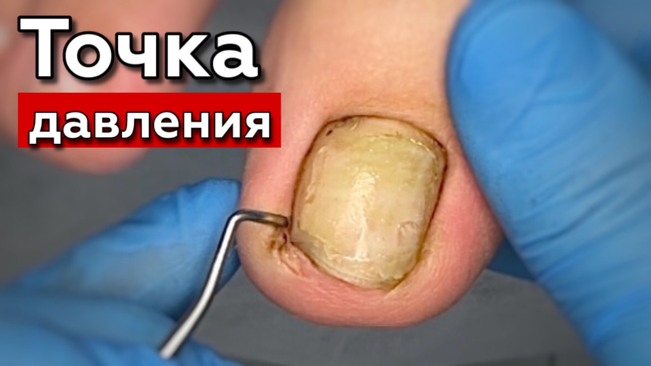 Где спрятался вросший уголок?