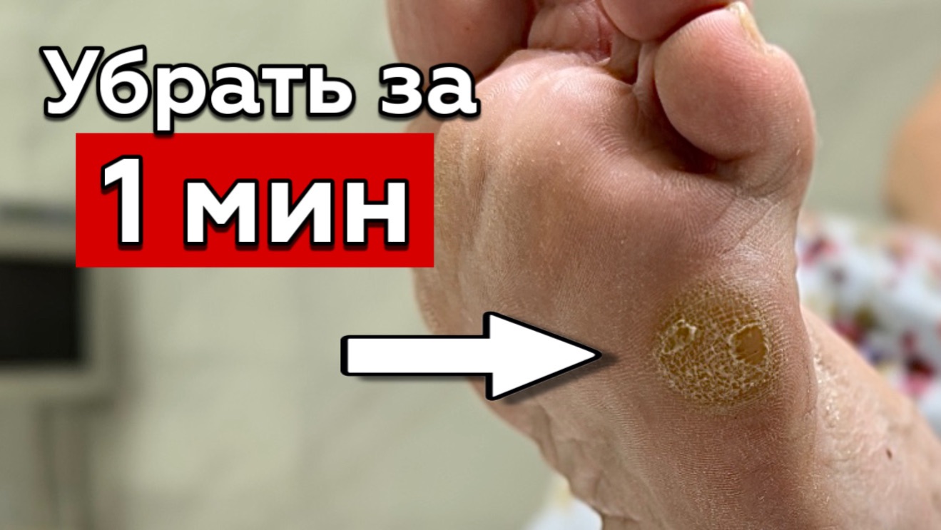 Удаление стержневой мозоли
