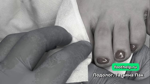 Нарастила ноготь и получилась травма с гематомой
