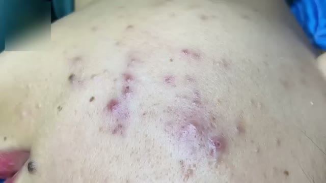 Процесс чистки лица от акне у косметолога