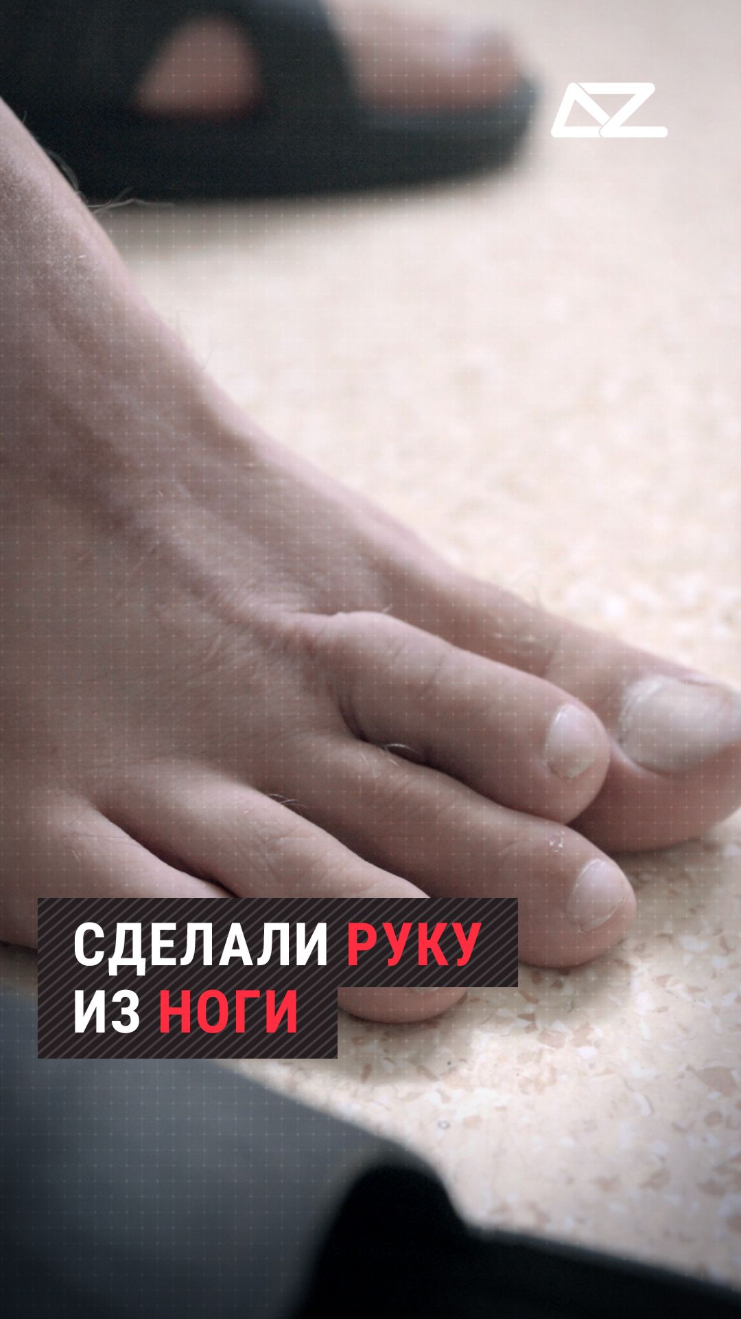 Бойцу сделали руку из ноги #доброизло #нога #рука #ступня #ладонь #операция #медицина #врач #доктор