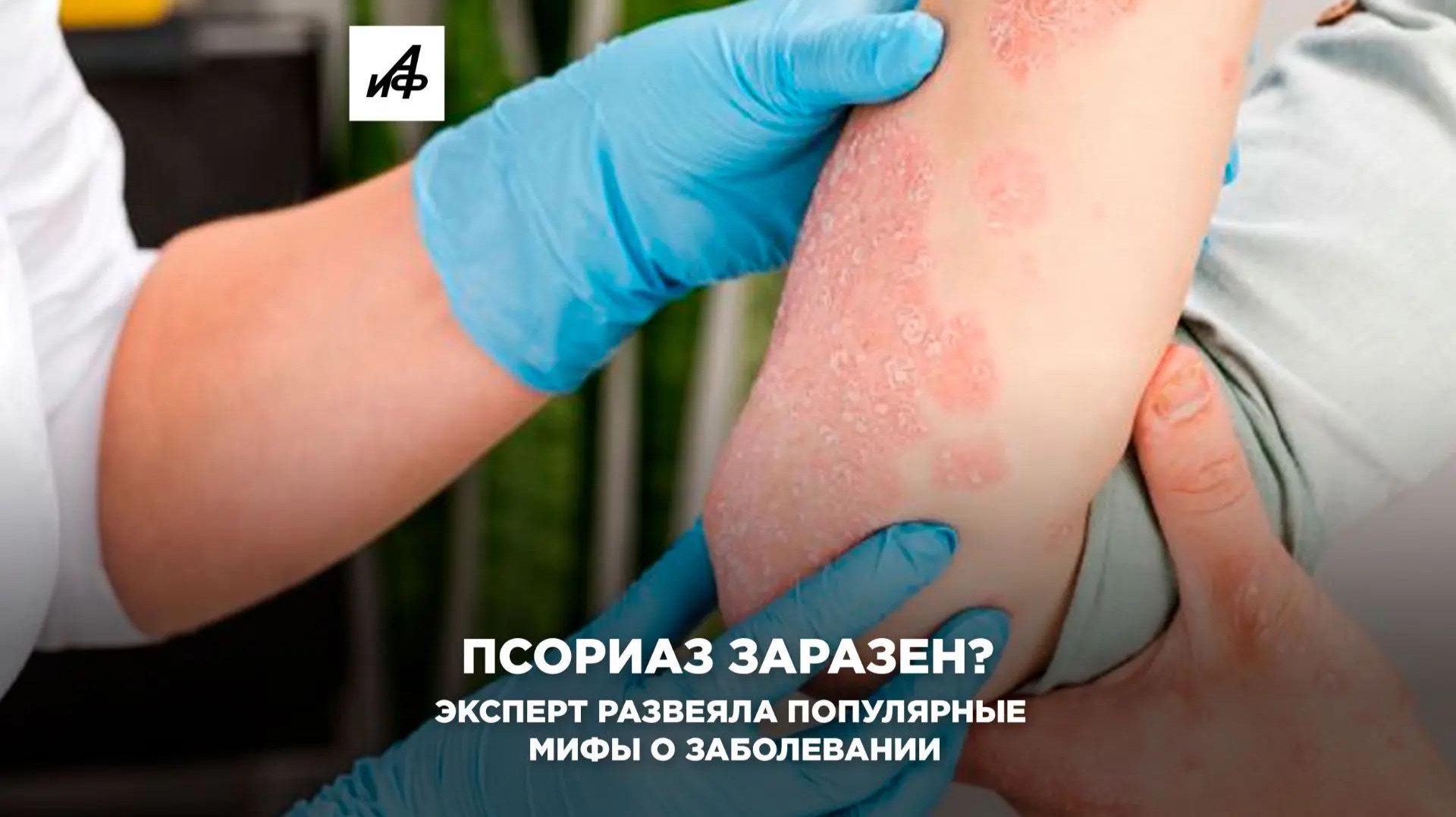 Псориаз заразен? Эксперт развеяла популярные мифы о заболевании