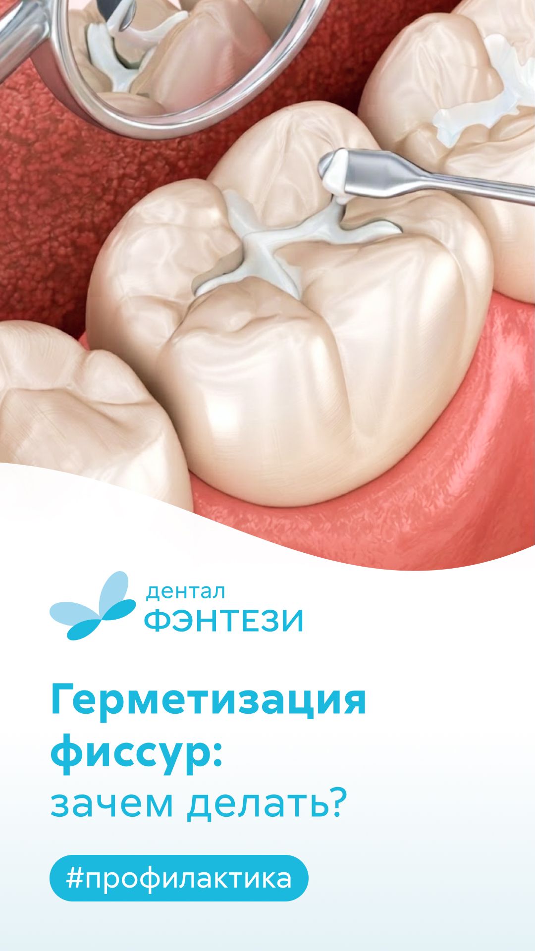 ⚡️ Лучший способ навсегда защитить зубы ребенка от кариеса!
