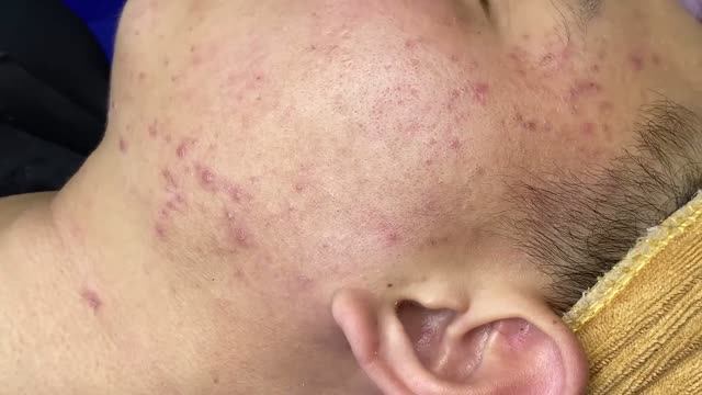 Удаление акне: видео работы