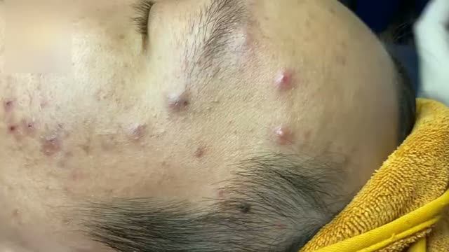 Чистка лица от комедонов: полный ход