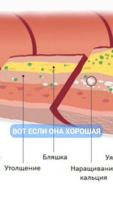 Статины нужны при гипертонии и плохом холестерине? #Шишонин