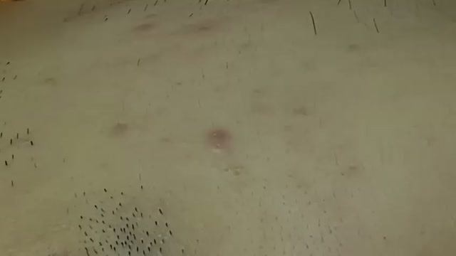 Чистка лица от прыщей: видео процесса