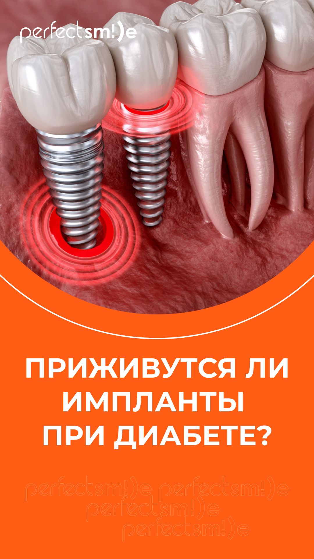 Имплантация зубов