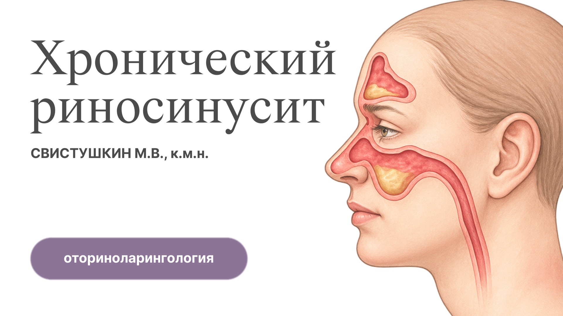 Хронический риносинусит — эндотипы, фенотипы и лечение | Оториноларингология