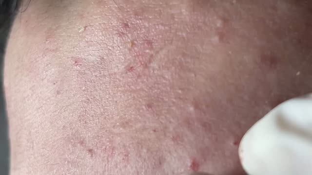 Удаление прыщей и акне: процесс
