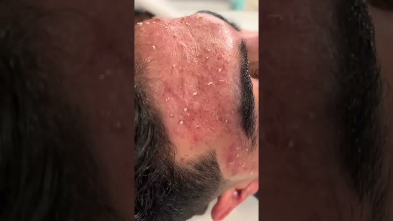 Удаление чёрных точек #skincare #shorts #pimple
