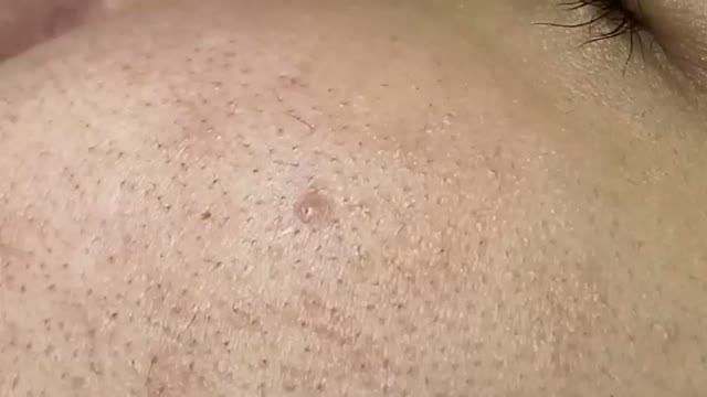 Процесс удаления комедонов и акне