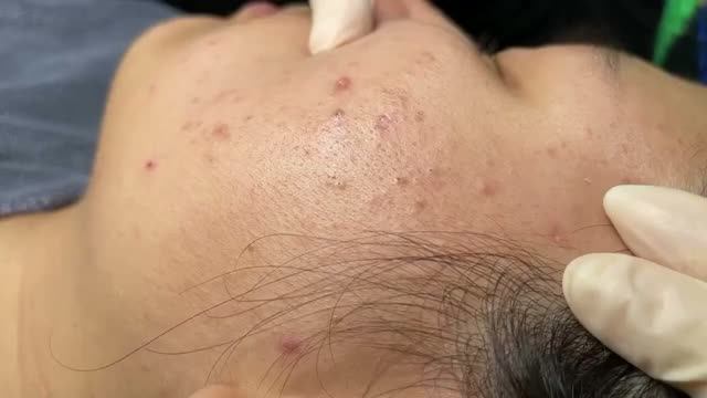 #1378 Удаление акне. Экстракция комедонов. Подкожные прыщи. Чистка от черных точек