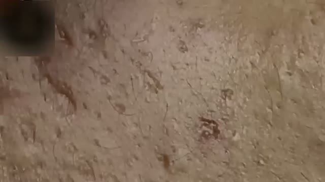 Удаление прыщей: видео процесса