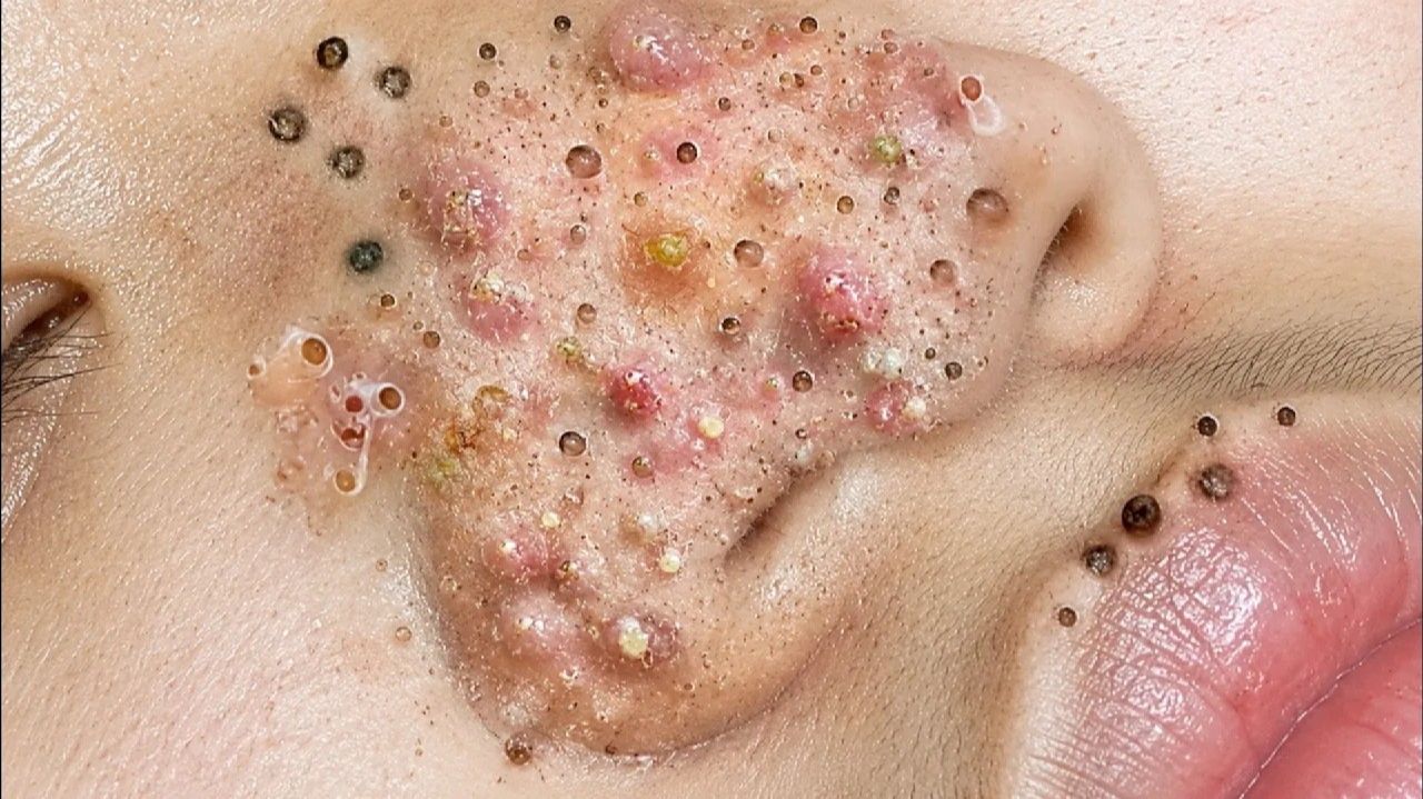 #прыщи #уходзакожей #ASMR #skincleaning #залипуха