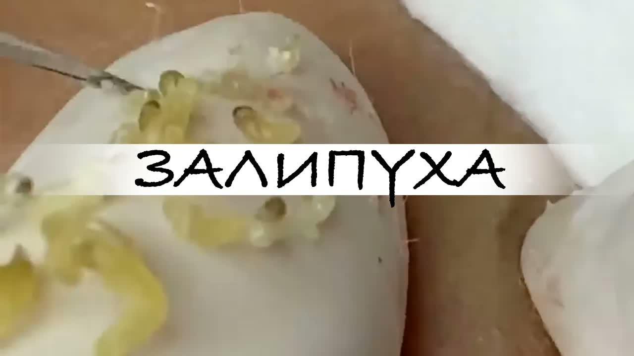 ПРЫЩИ  ПРЫЩИ ВЫДАВЛИВАНИЕ  ПОДБОРКА ВЫДАВЛИВАНИЕ ПРЫЩЕЙ прыщи acne asmr прыщиналице