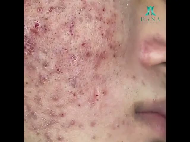 Relax Squeezing Out Blackheads #2 Смачные Черные точки #2