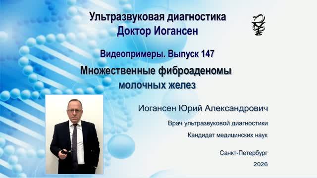 УЗИ. Доктор Иогансен. Видеопримеры. Выпуск 147. Множественные фиброаденомы молочных желез.