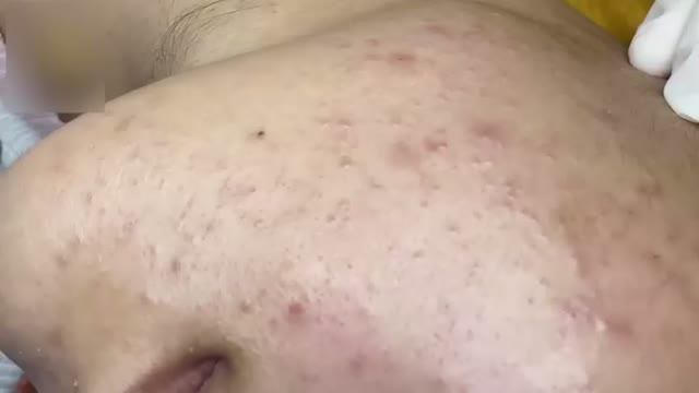 Удаление акне: чистка у специалиста
