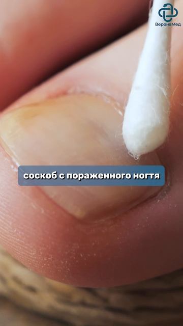 Первые признаки грибка ногтей #грибокногтей #онихомикоз  #грибок #дерматолог #лечение #препараты