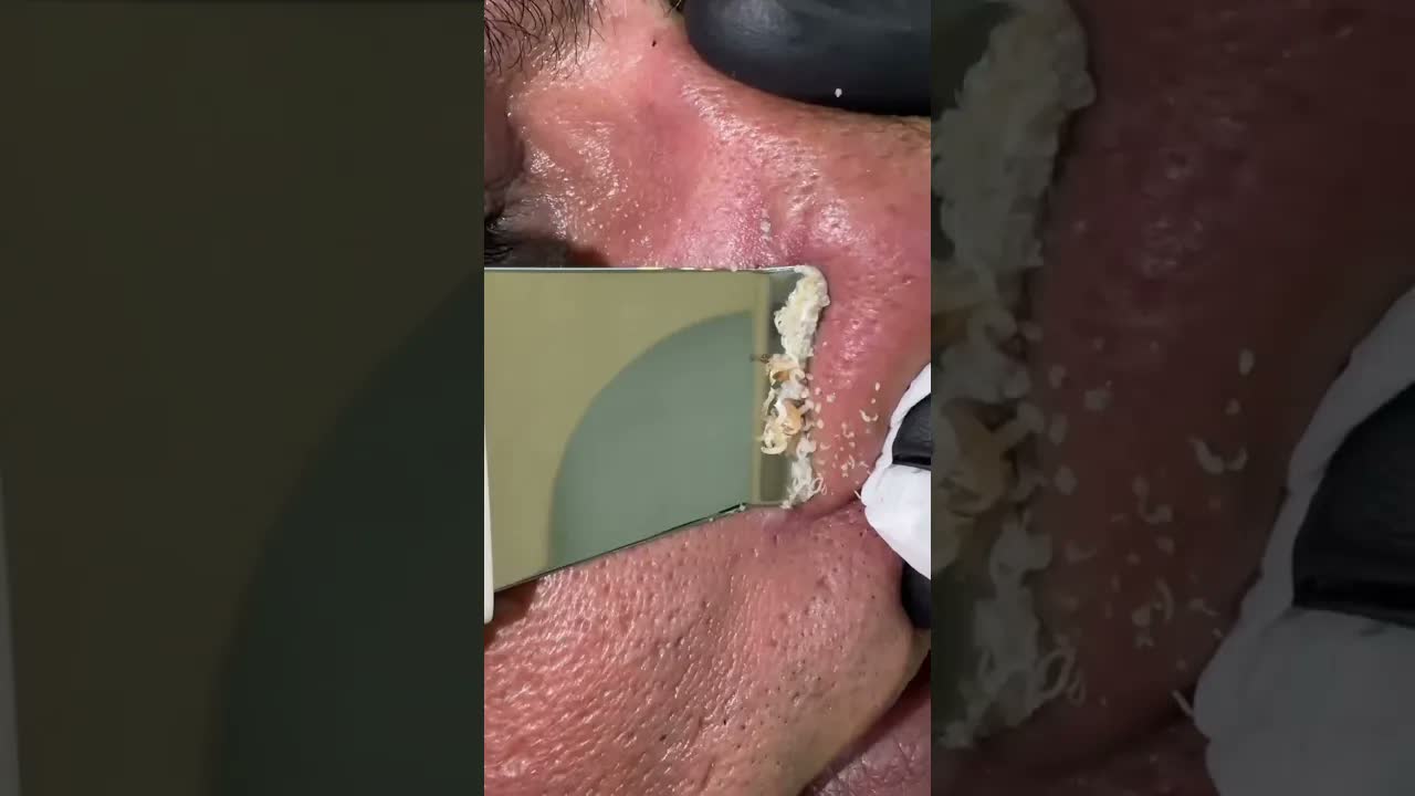 Тег Shorts чёрные точки #blackheads